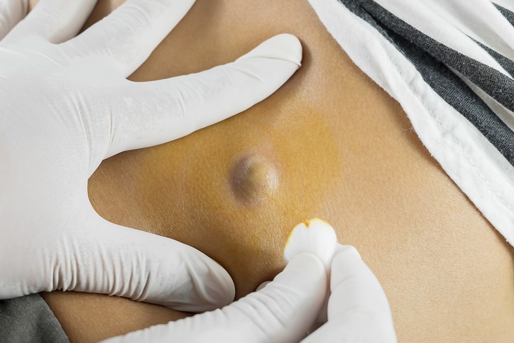 Cyst and Lump Removal Surgery in Delhi